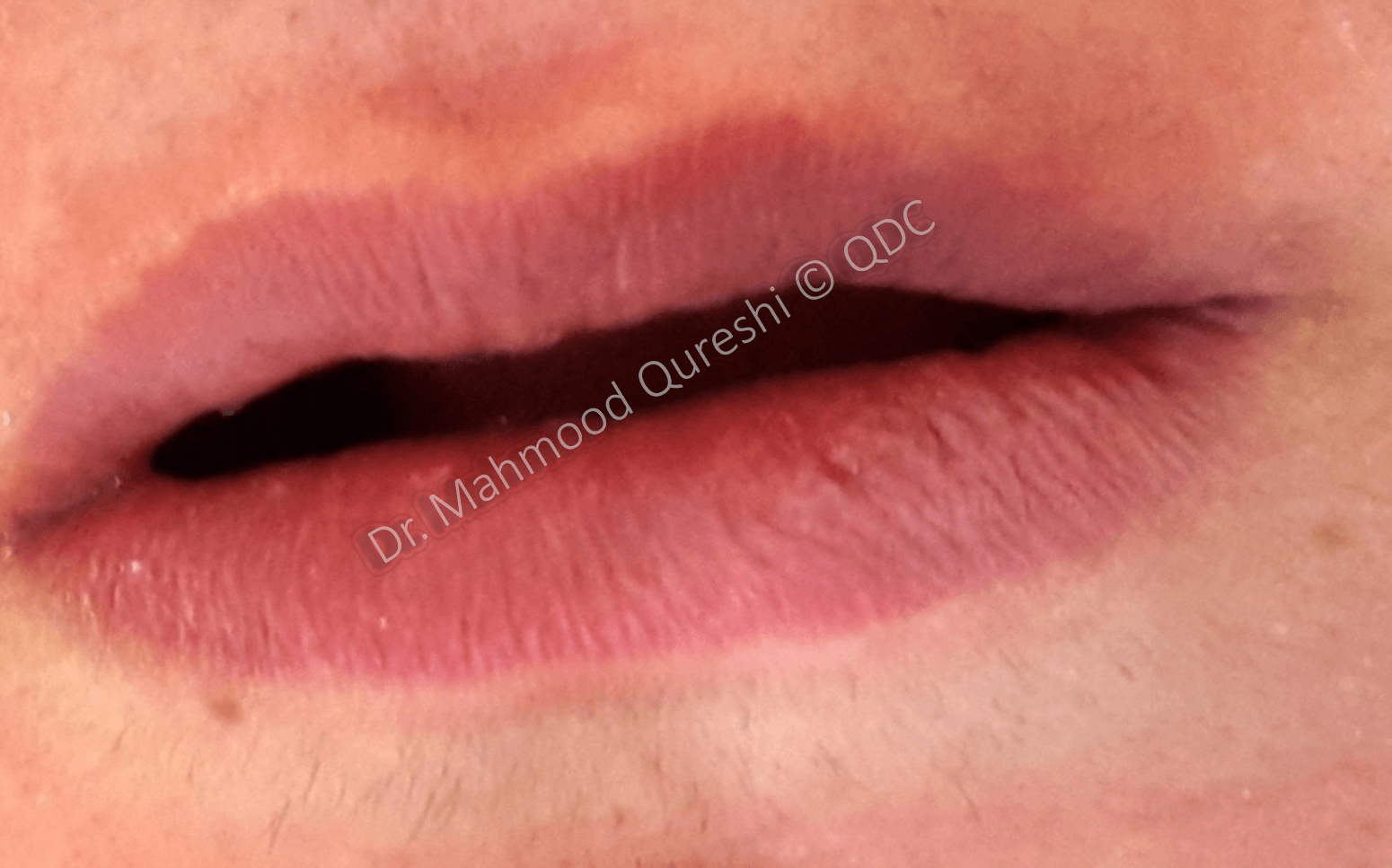 Before Treatment